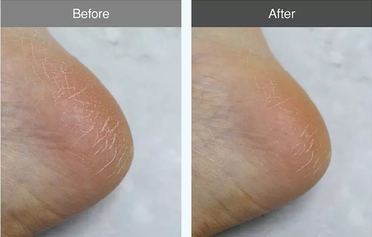Derma B | Urea 9.8% Foot Cream